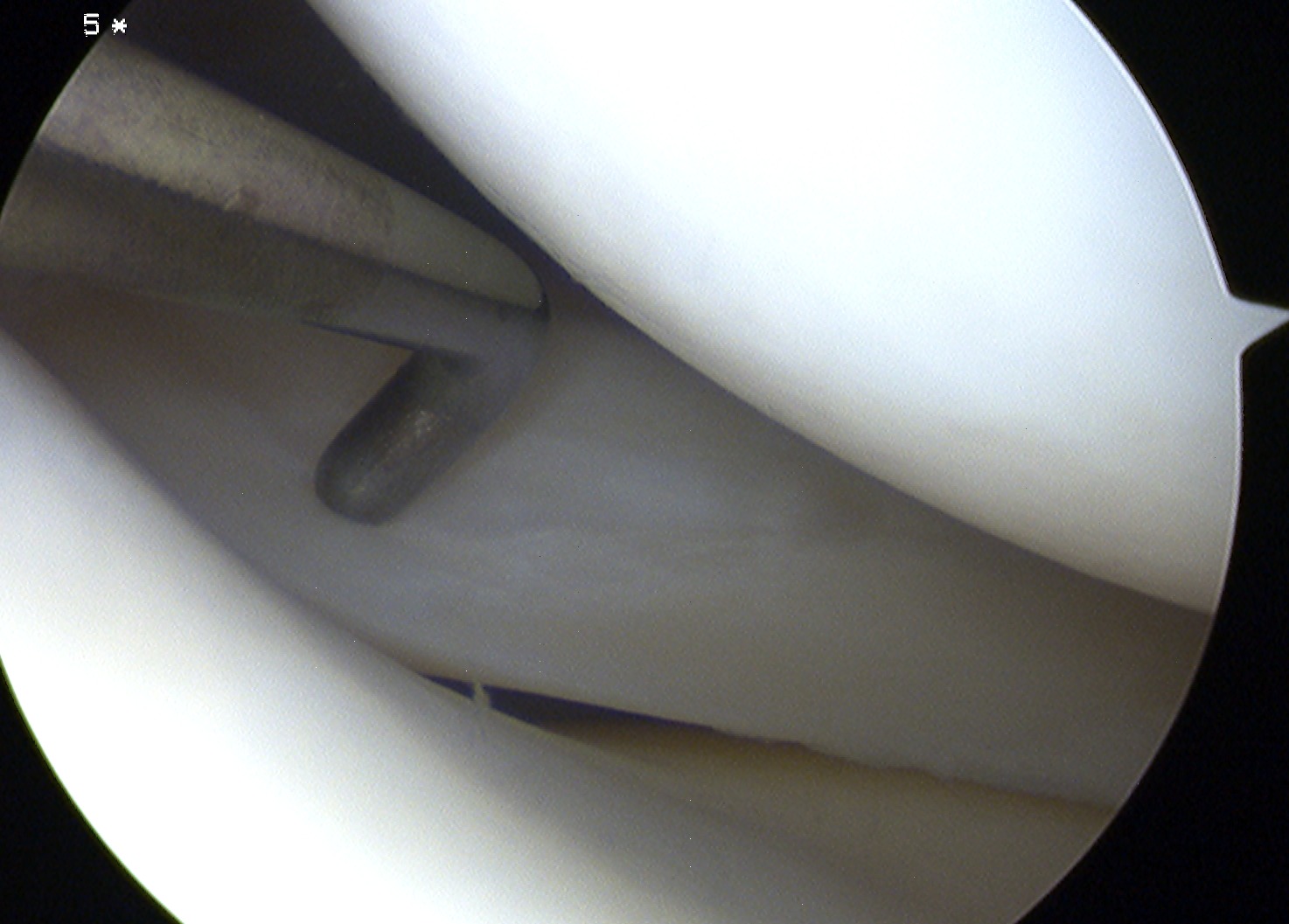 Knee Arthroscopy Healed Meniscal Tear Lateral Meniscus Top Surface